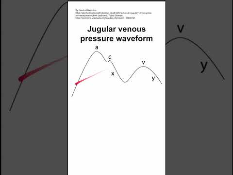Jugular venous pressure waveform